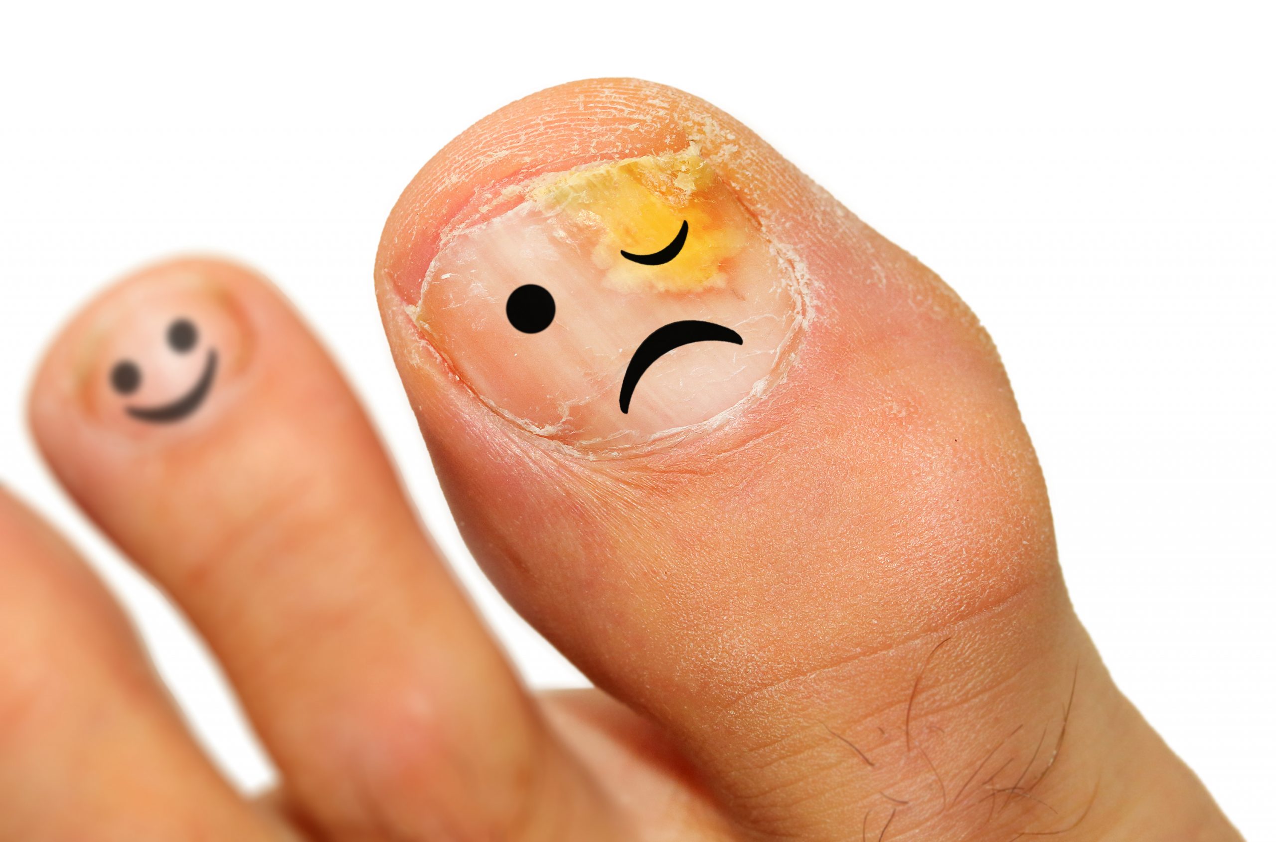 How to manage toenail fungus in children