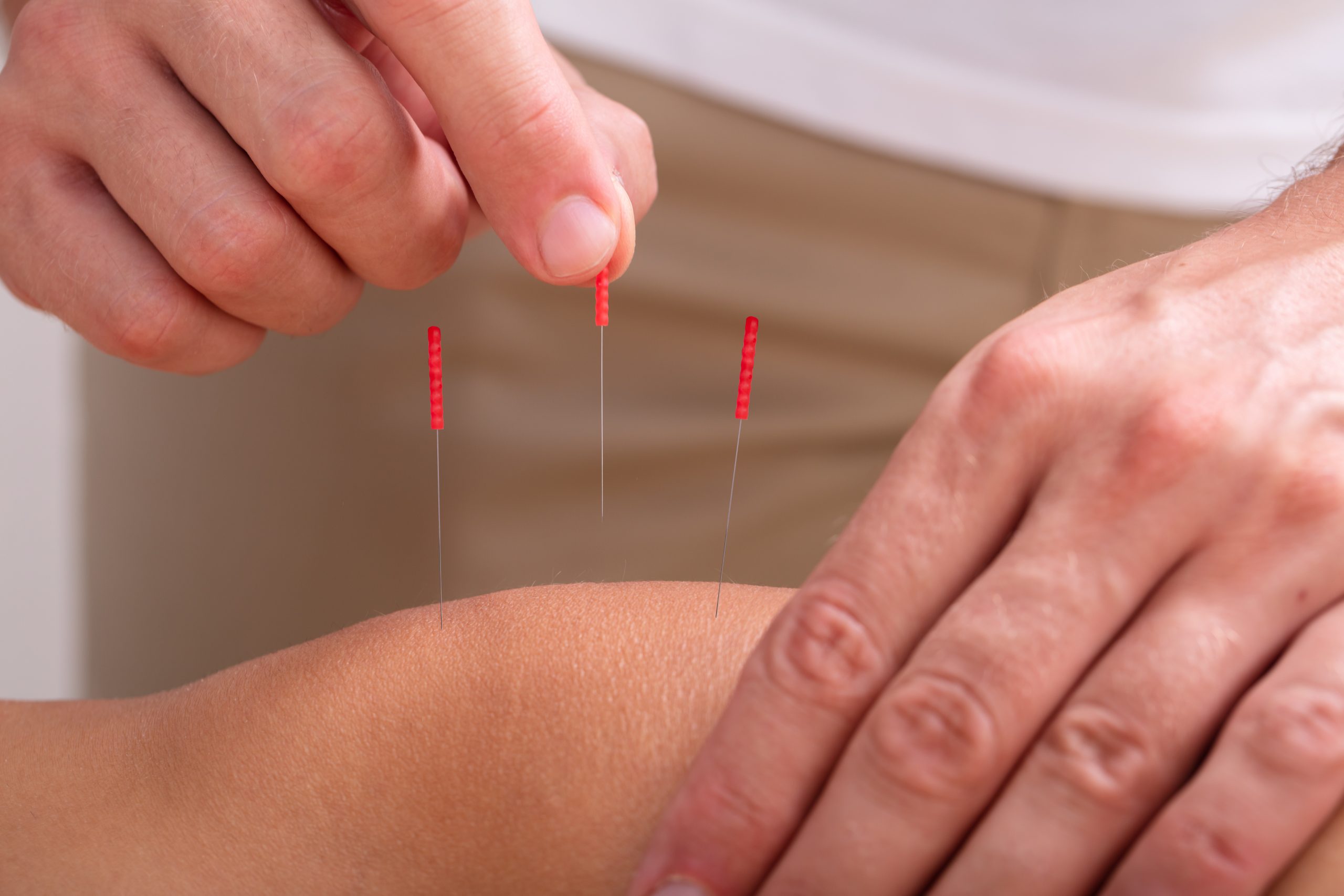 The Benefits of Acupuncture for Joint Pain